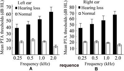 Changes of the Brain Causal Connectivity Networks in Patients With Long-Term Bilateral Hearing Loss